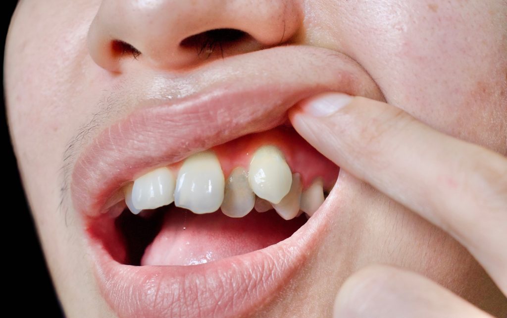 How To Tell You've Got A Bad Bite?- Wollongong Dentist 4 U